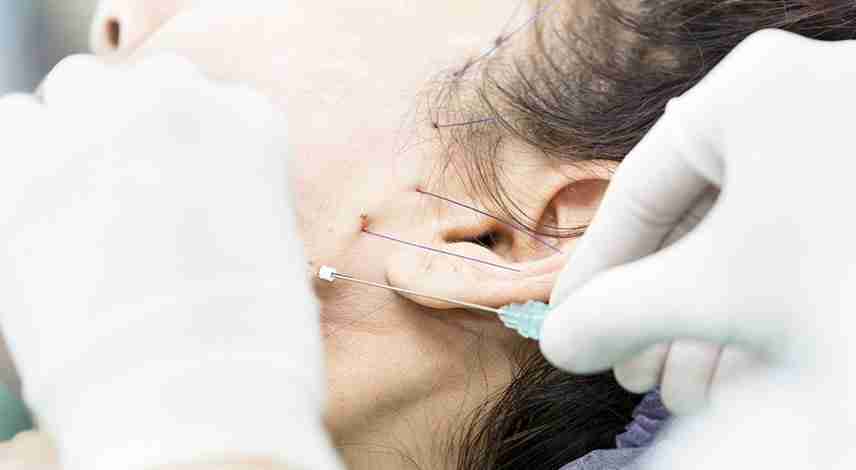What to Expect During and After PDO Thread Lift Treatment
