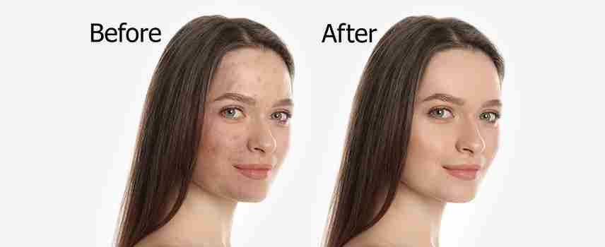 Before and after chemical peel treatment