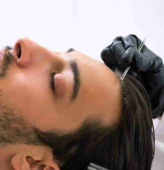 man undergoing pdo thread lift for hair growth