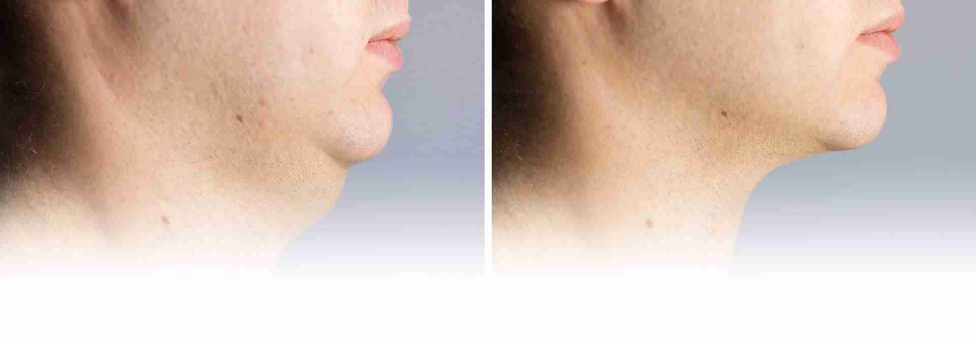 a side view of a man's face and neck after receiving injection lipolysis treatment