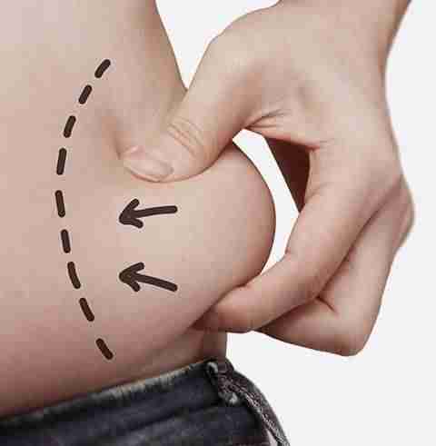 a man's stomach with arrows drawn on it for Injection Lipolysis treatment