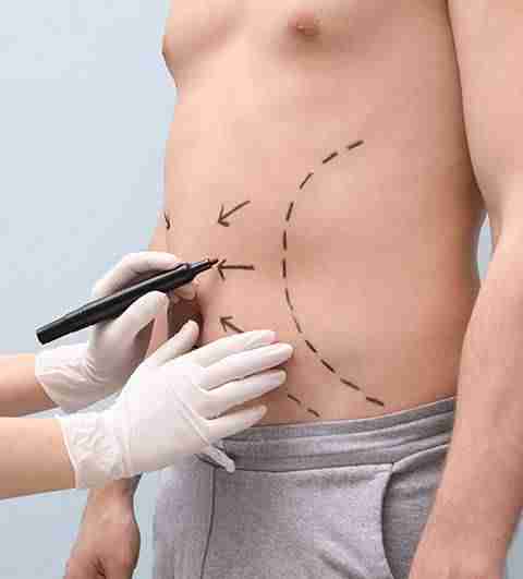 hands of a practitioner injecting kybella into the patient's belly